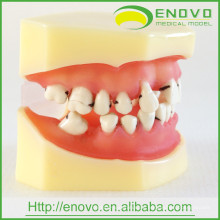 DE-L4 Peridontale Disease Dental Modell mit abnehmbarem weichem Zahnfleisch